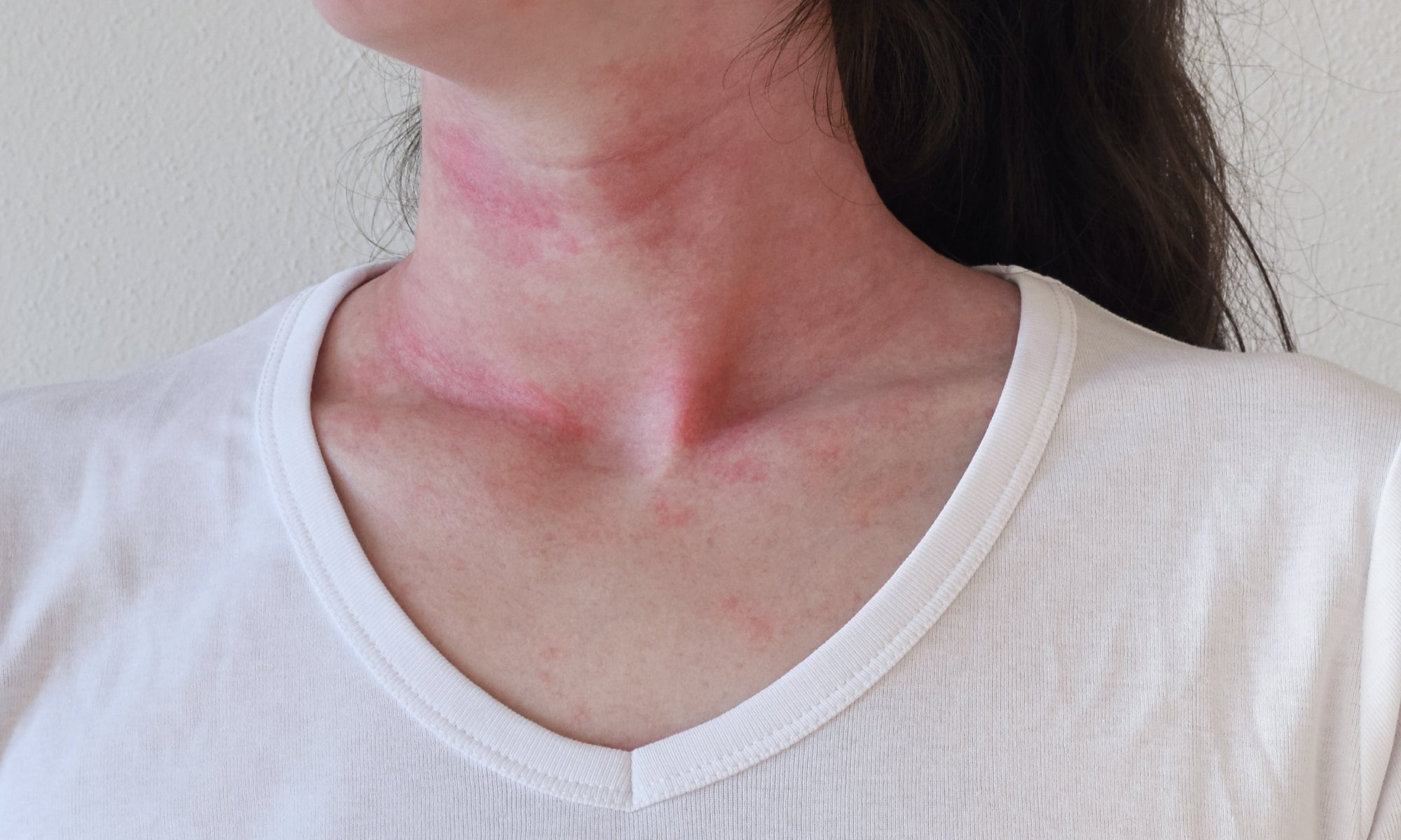 Identifying Triggers For Eczema Flare-Ups And Skin Sensitivities