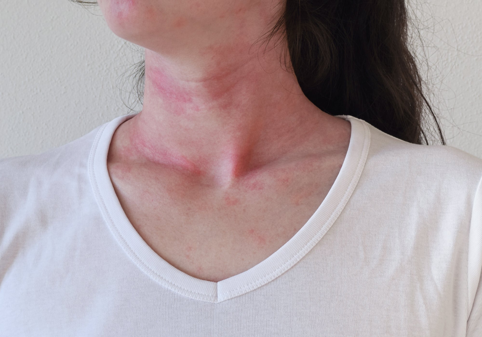 Identifying Triggers For Eczema Flare-Ups And Skin Sensitivities