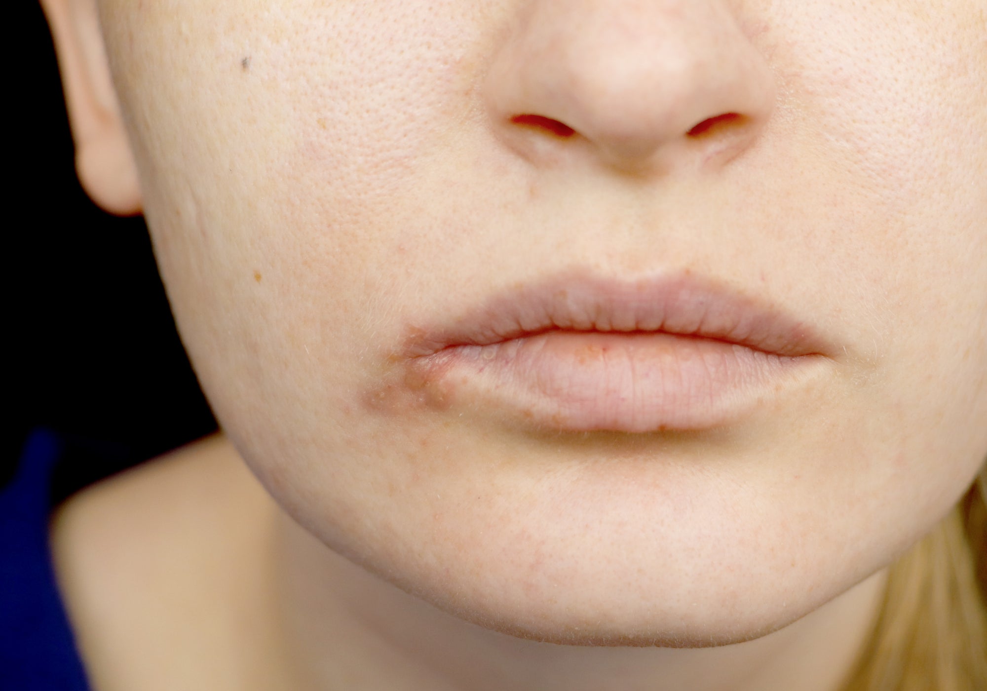 Is Periorial Dermatitis A Fungal Condition?
