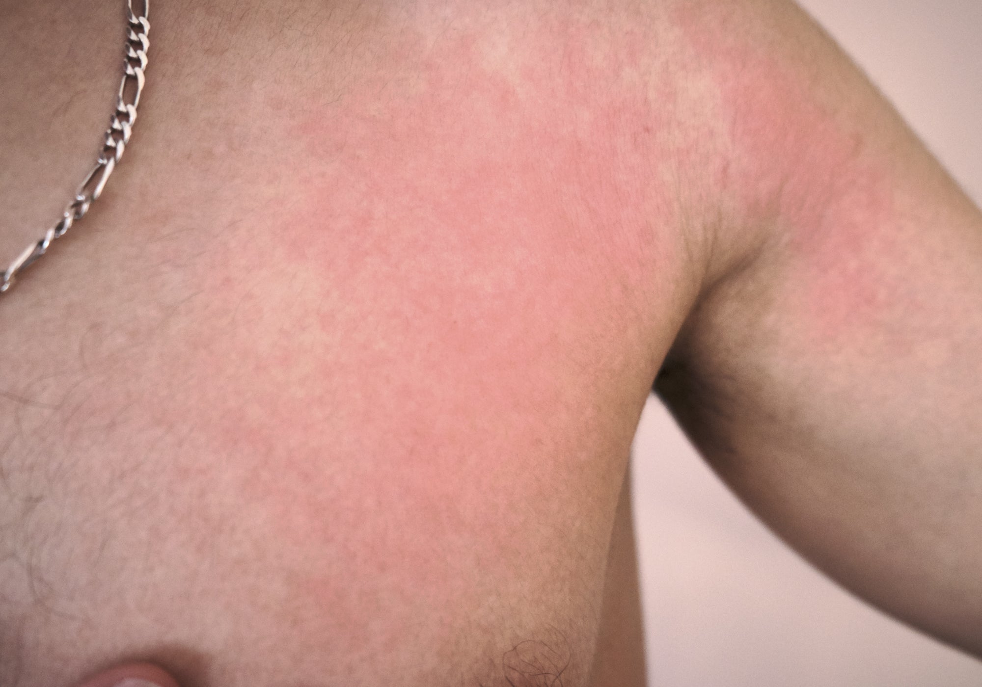 radiation rash on chest