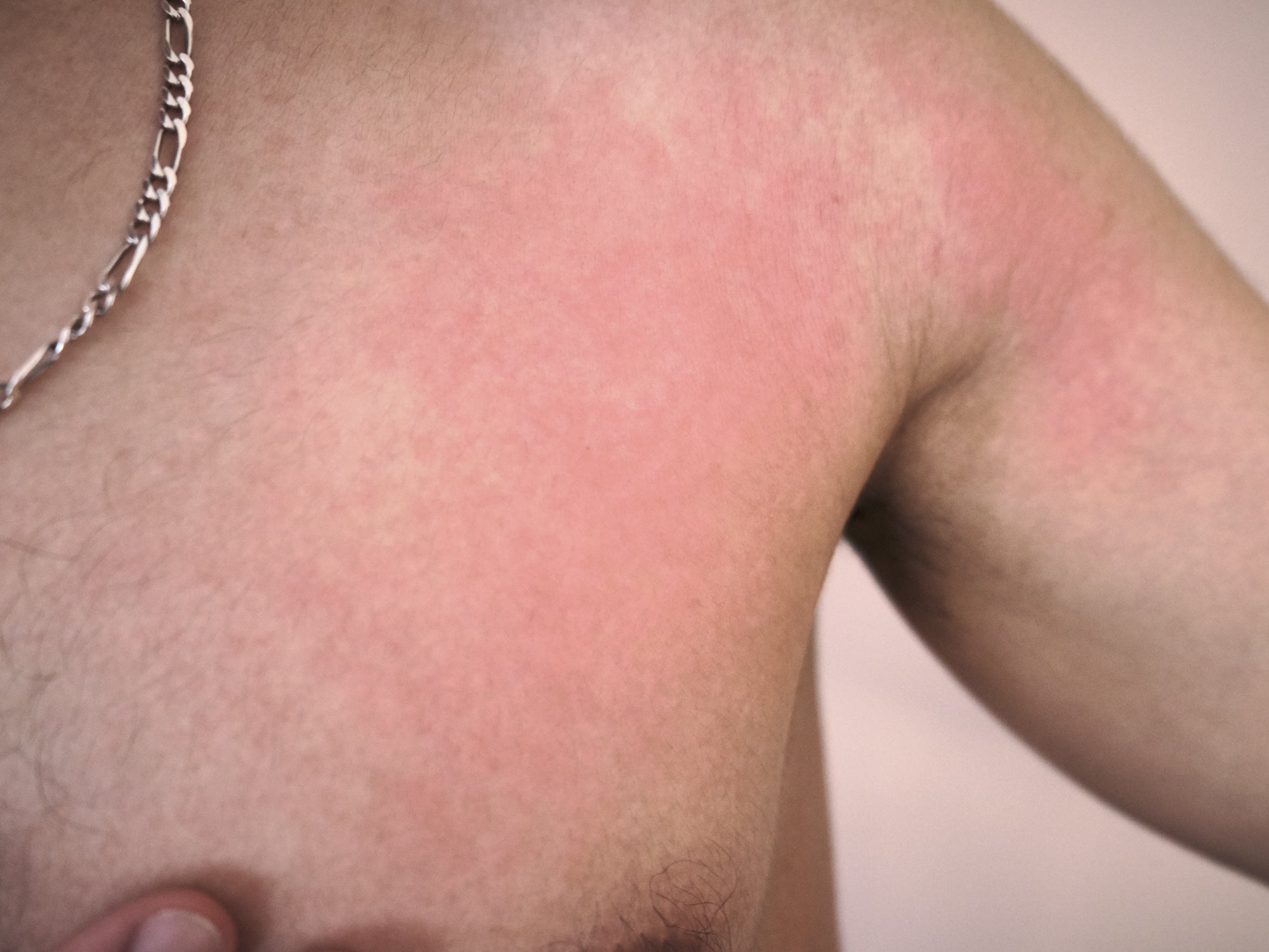 Radioiodine Rash Can Radiation Therapy Cause A Rash? – Balmonds