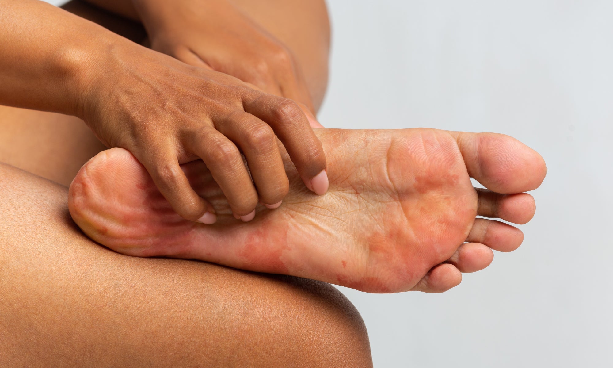 How To Soothe Diabetic Itchy Feet