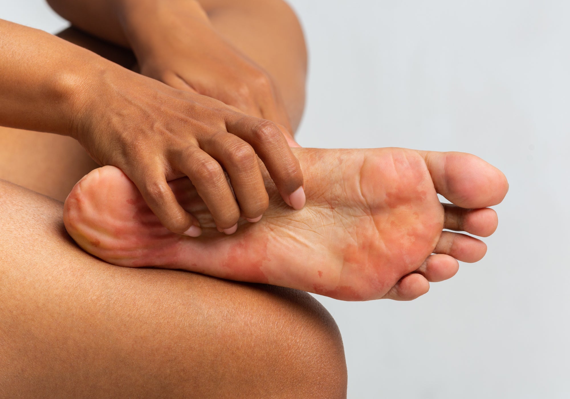 How To Soothe Diabetic Itchy Feet