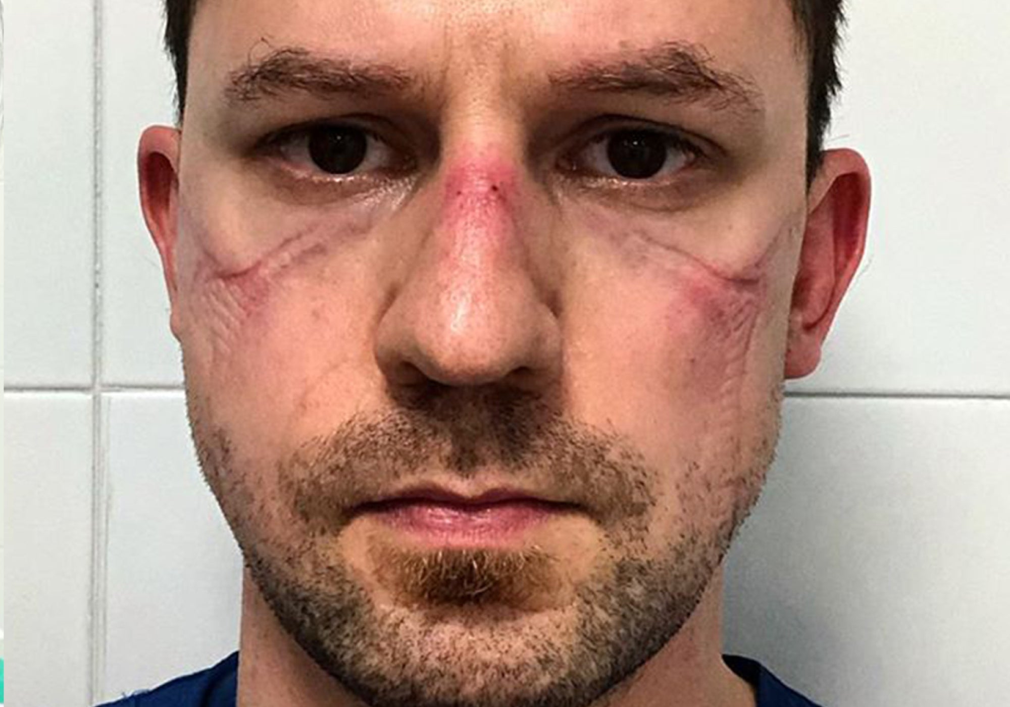 How To Avoid Skin Irritation From PPE Face Masks During COVID-19