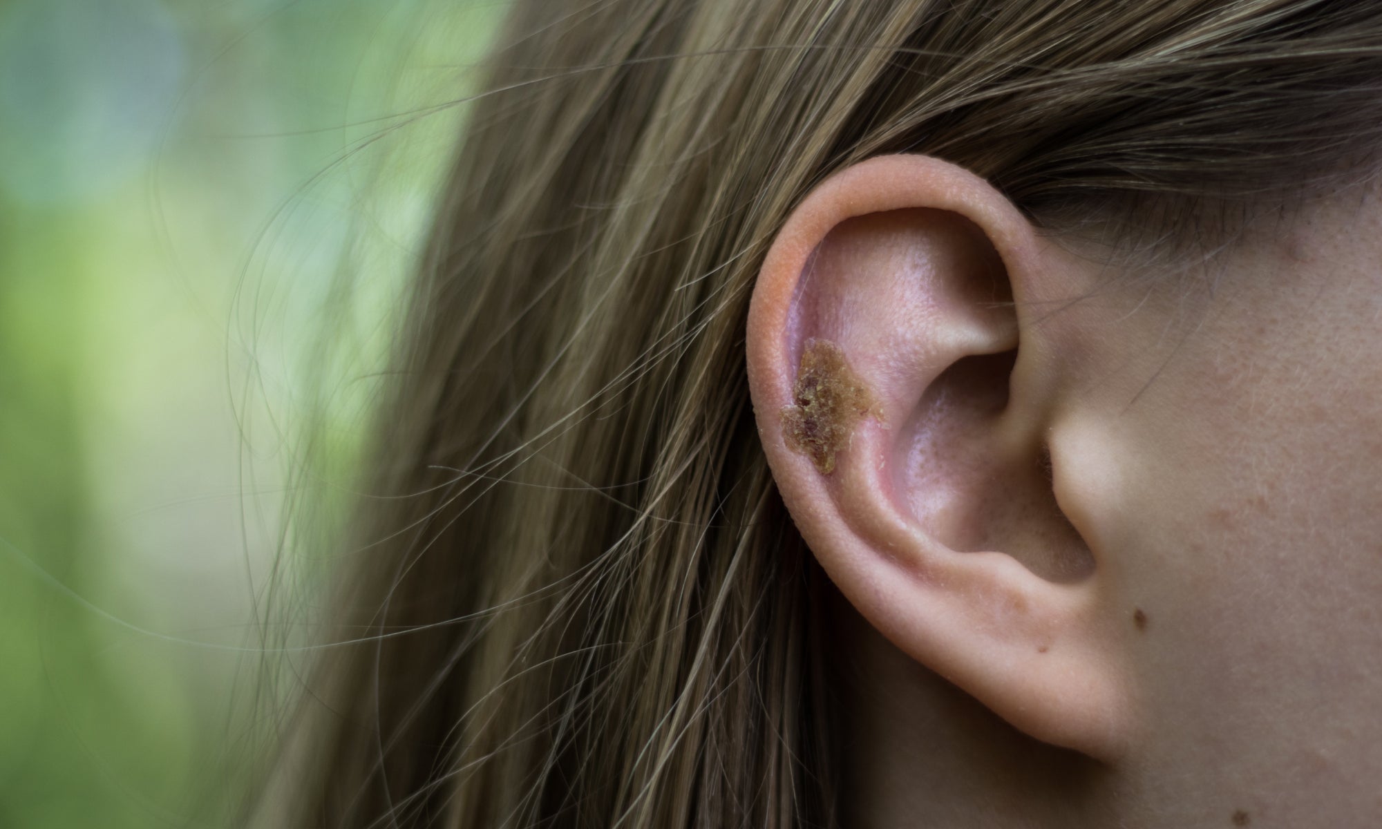 Is My Ear Eczema Infected? The Signs And Symptoms Of Aural Dermatitis 