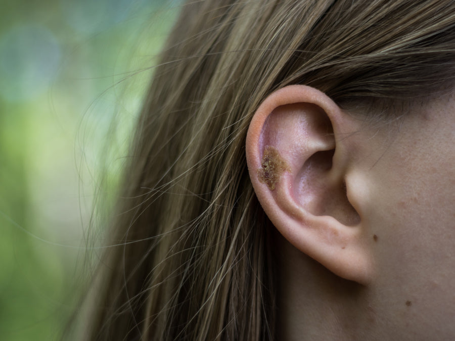 Ear Infection Causing Rash Is My Ear Eczema Infected? The Signs And Symptoms Of Aural Dermatitis ...