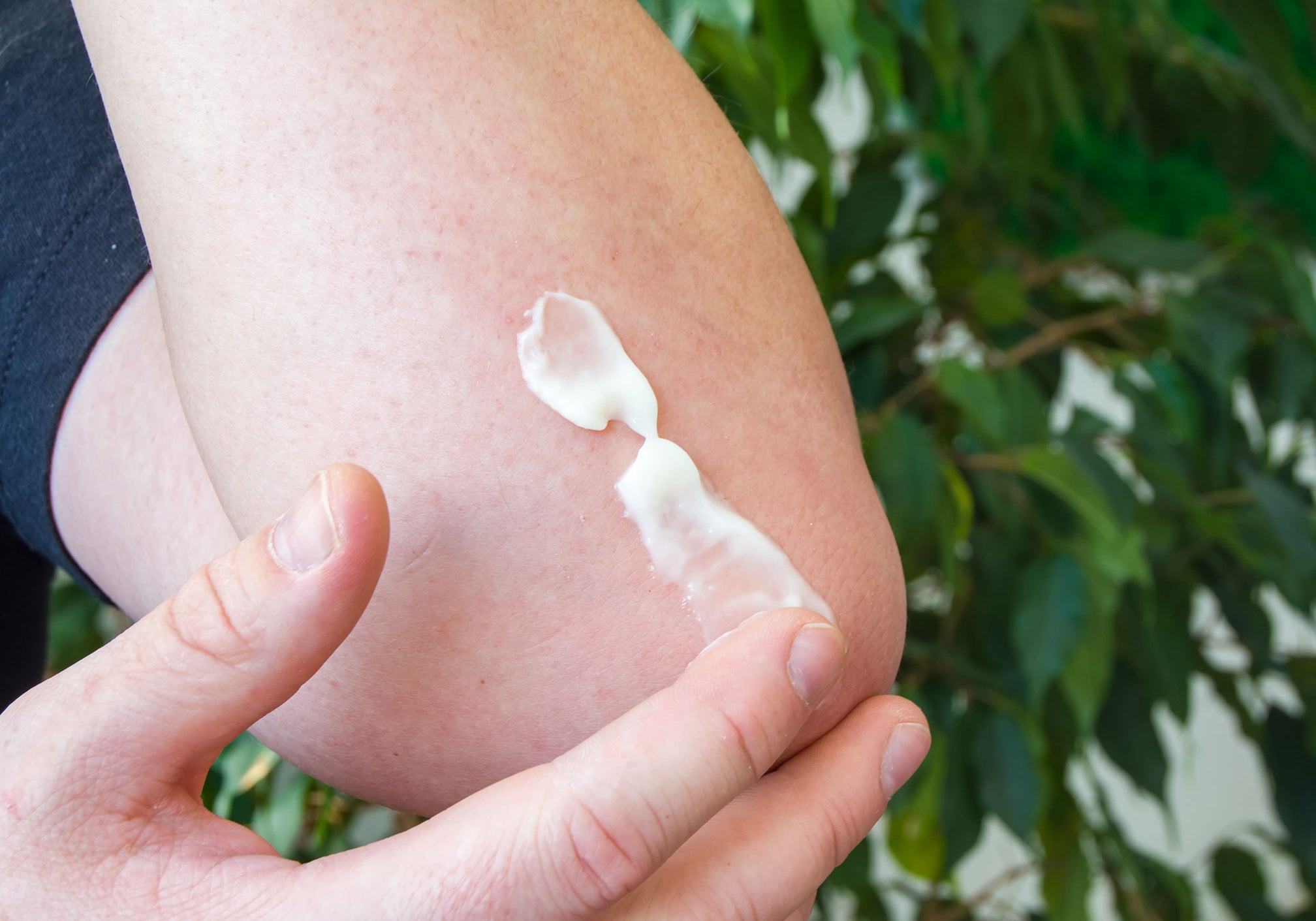 5 Toxic Ingredients To Avoid In Eczema Creams