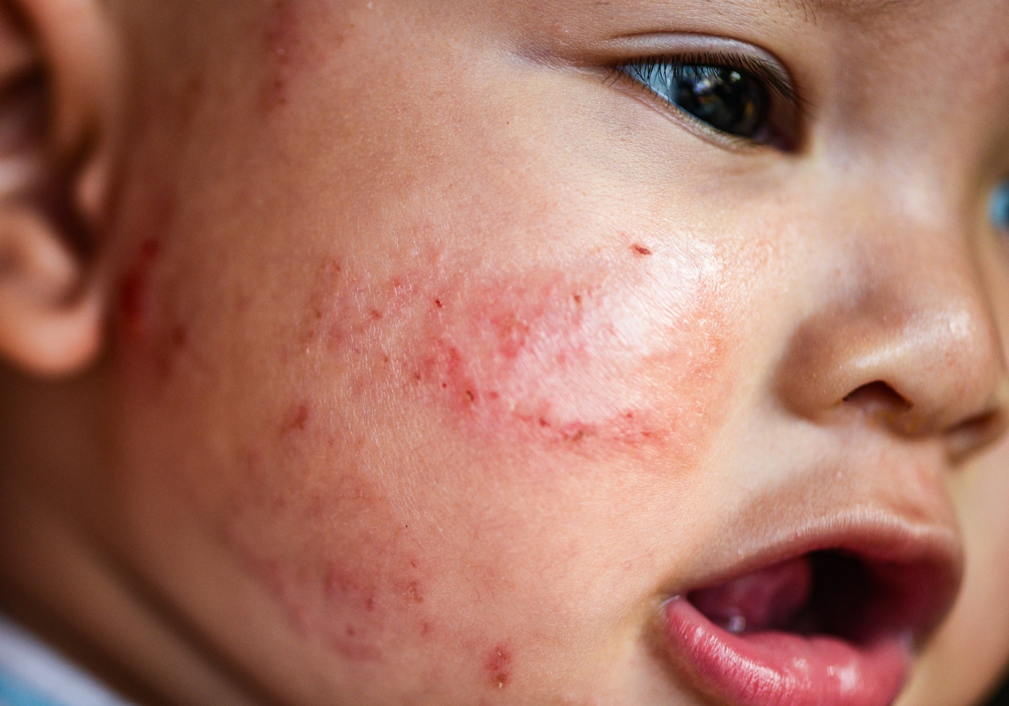 How To Wet Wrap Face Eczema