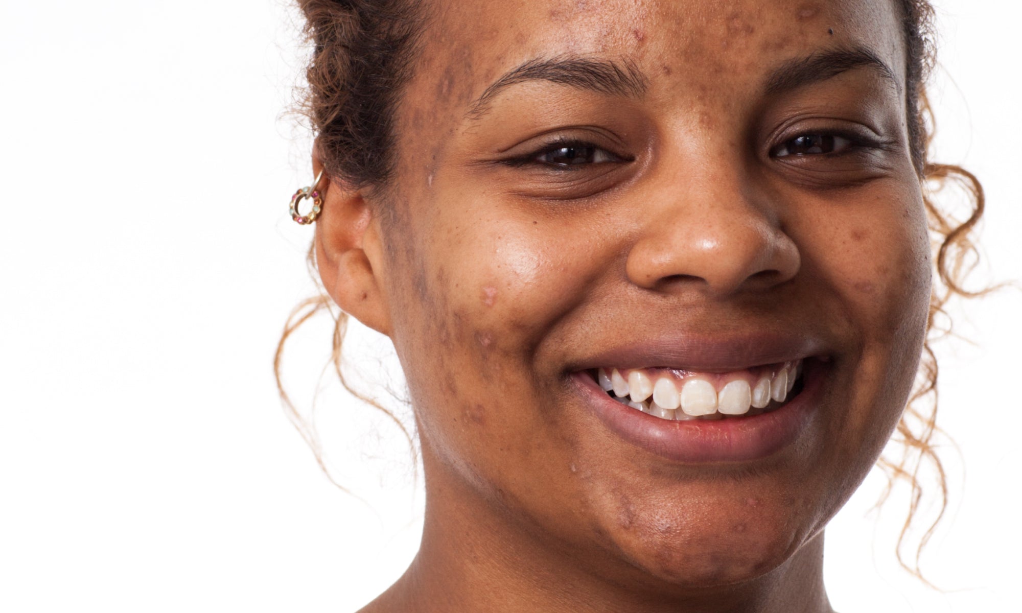 How To Get Rid Of Post-Inflammatory Hyperpigmentation 