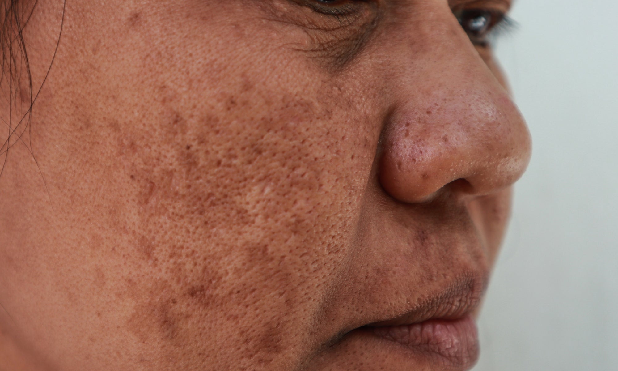 Is There A Natural Treatment For Post-Inflammatory Hyperpigmentation That Actually Works?