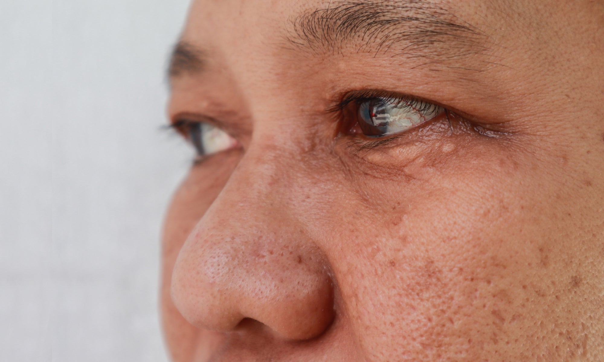 What Is Post-Inflammatory Hyperpigmentation? 