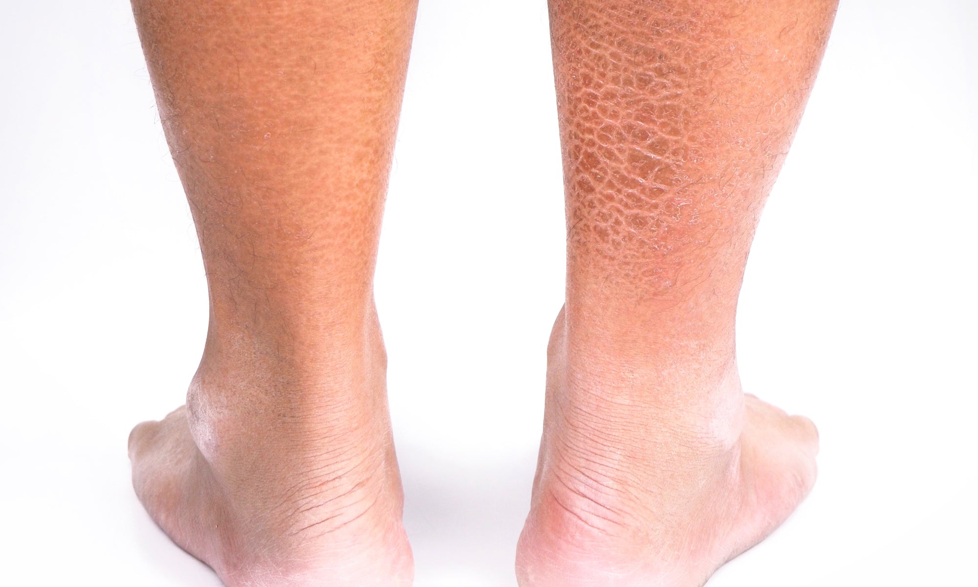 What Part Of The Skin Is Affected By Ichthyosis?