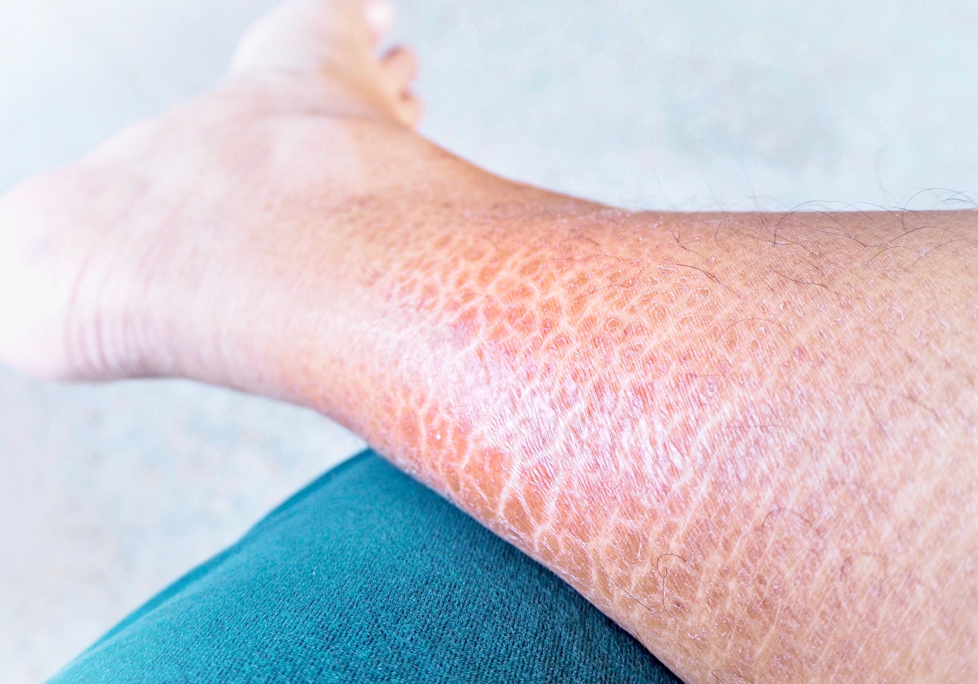 How Is Ichthyosis Inherited?