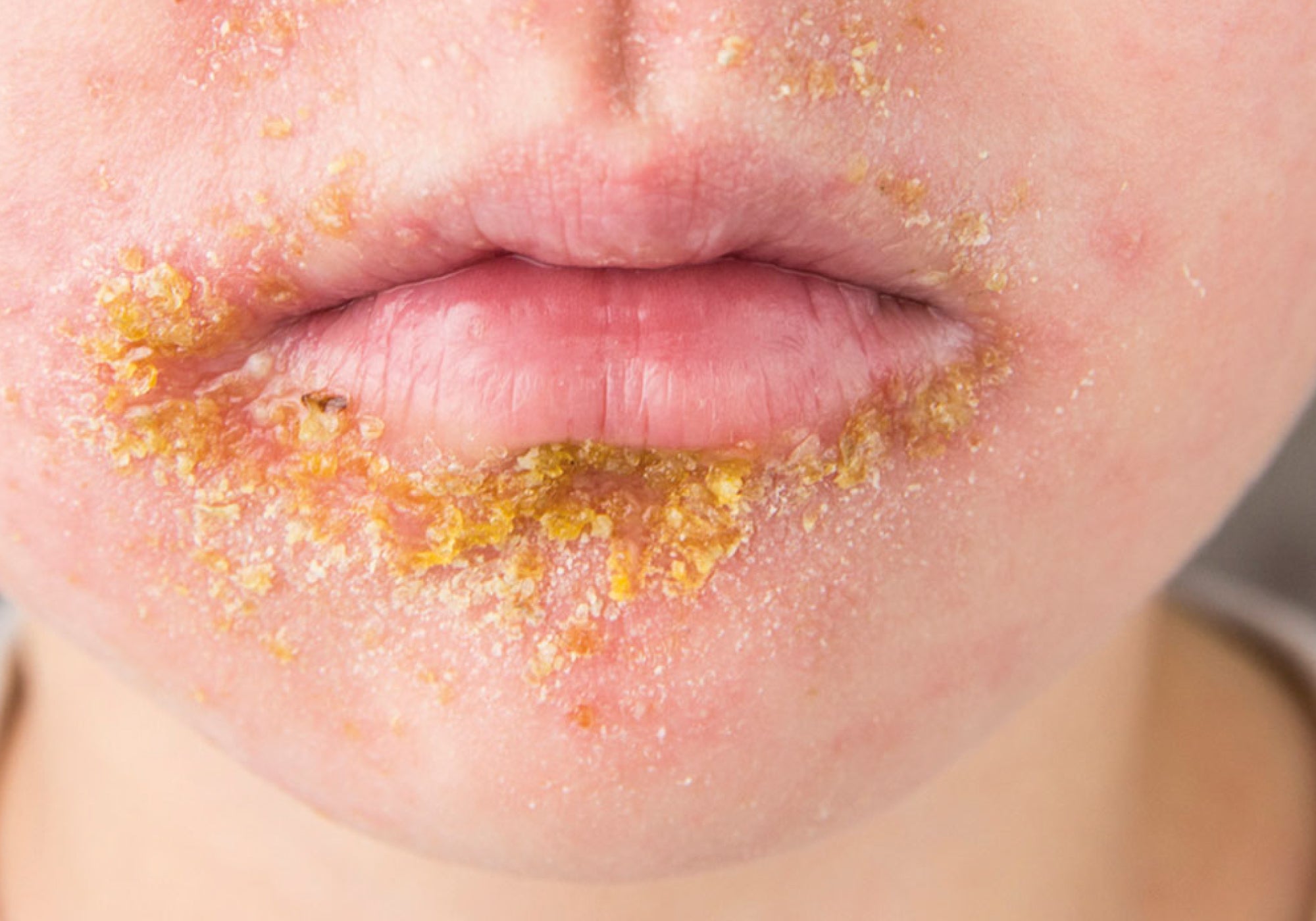 What Is The Difference Between Perioral Dermatitis And Impetigo?