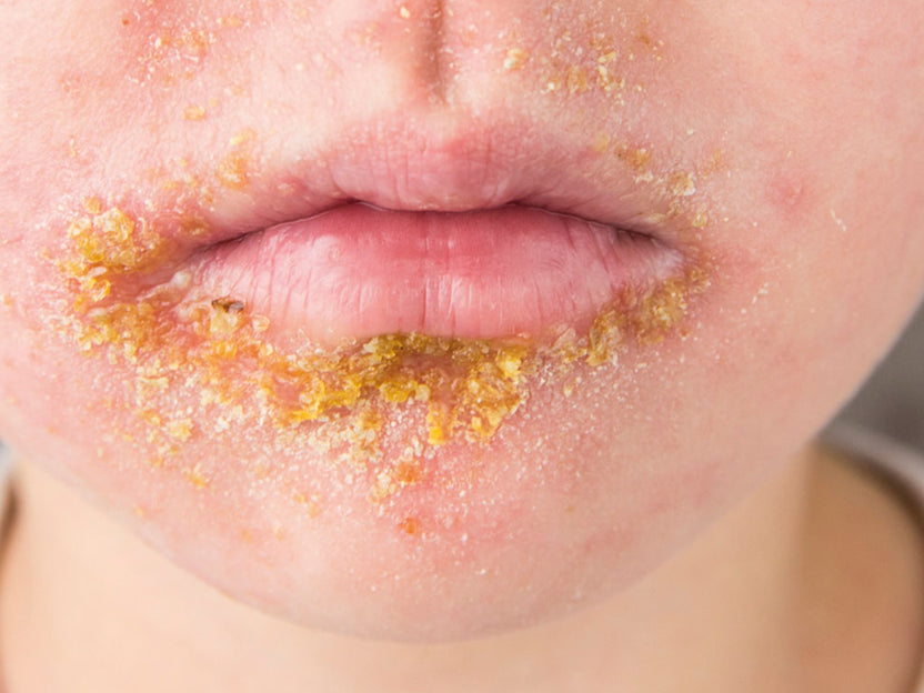 What Is The Difference Between Perioral Dermatitis And Impetigo? Balmonds