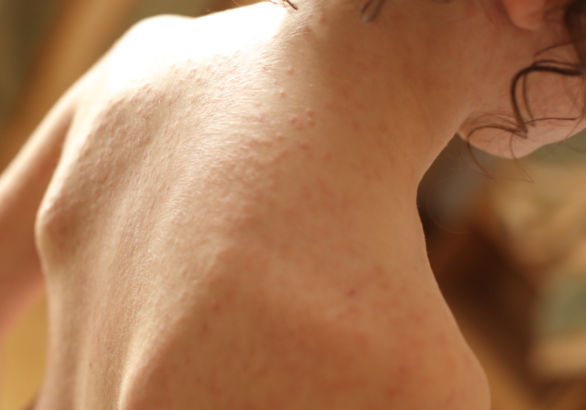Can You Put A Wet Wrap On Infected Eczema?