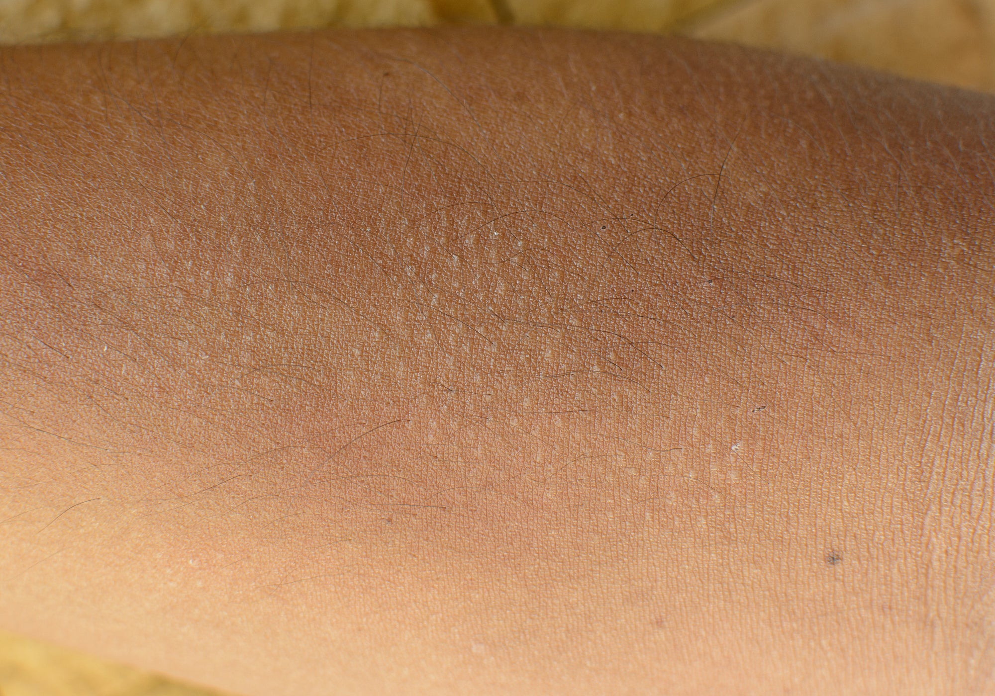 What Is Keratosis Pilaris And What Causes It?
