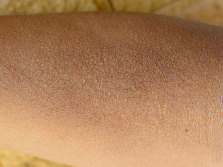 What Is Keratosis Pilaris And What Causes It?