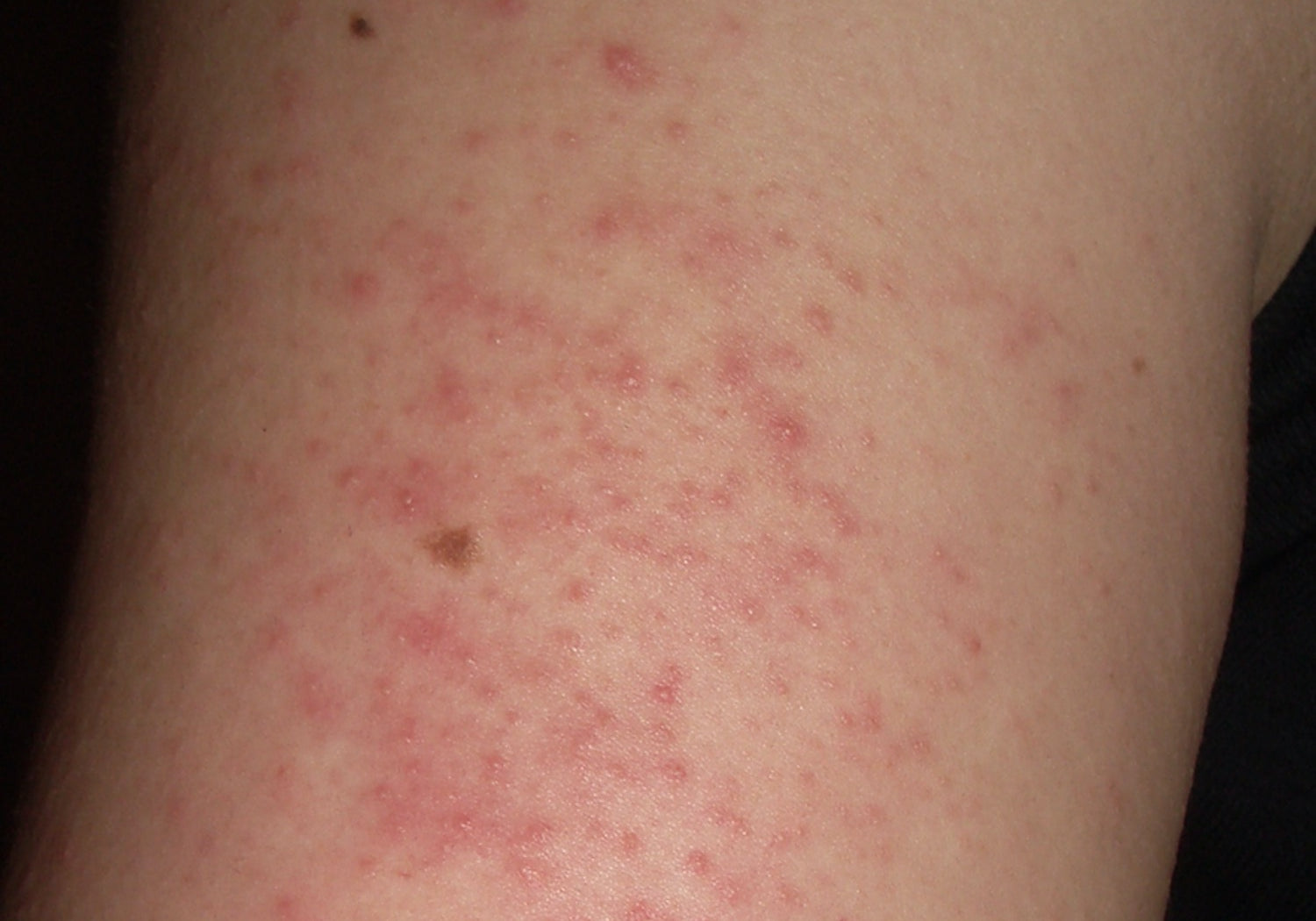 What Does Keratosis Pilaris Look Like?