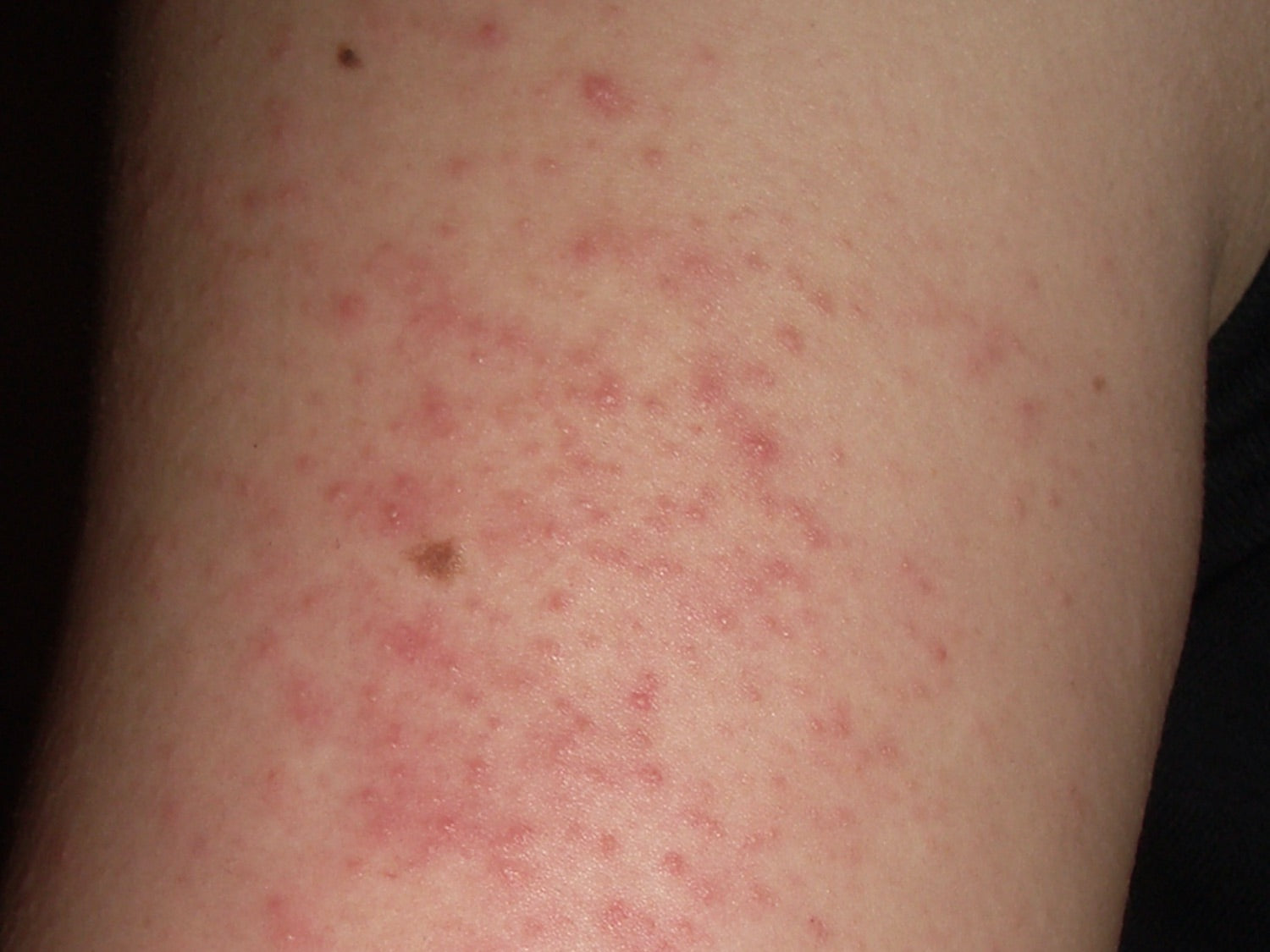 What Does Keratosis Pilaris Look Like?