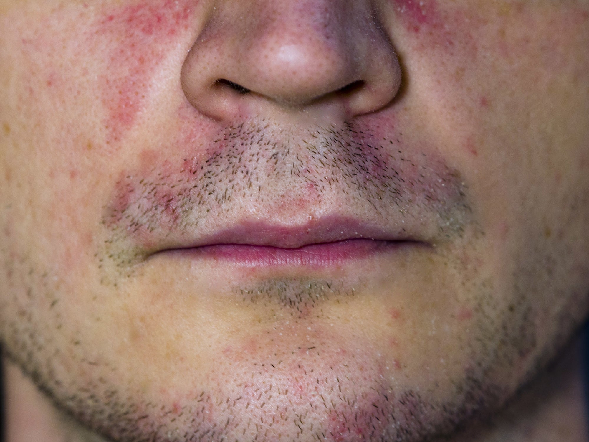 How To Treat Perioral Dermatitis