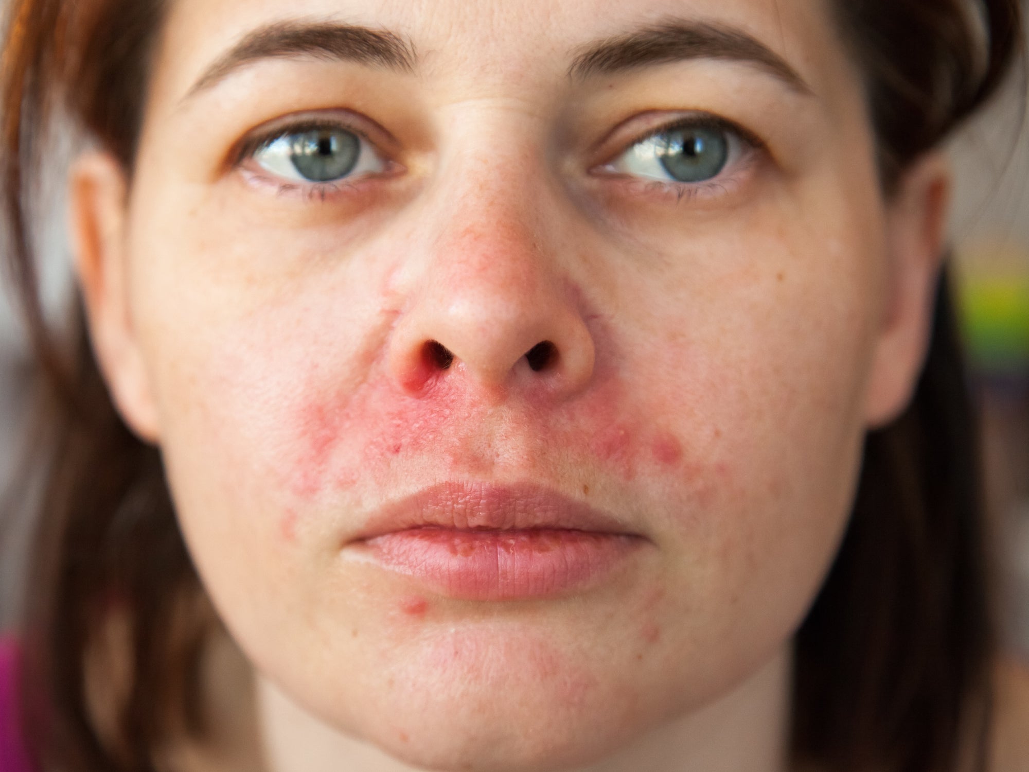 What Is Perioral Dermatitis?