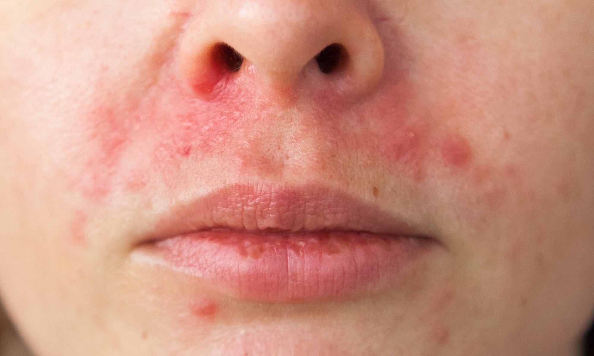 What Home Remedies Are Good For Perioral Dermatitis?