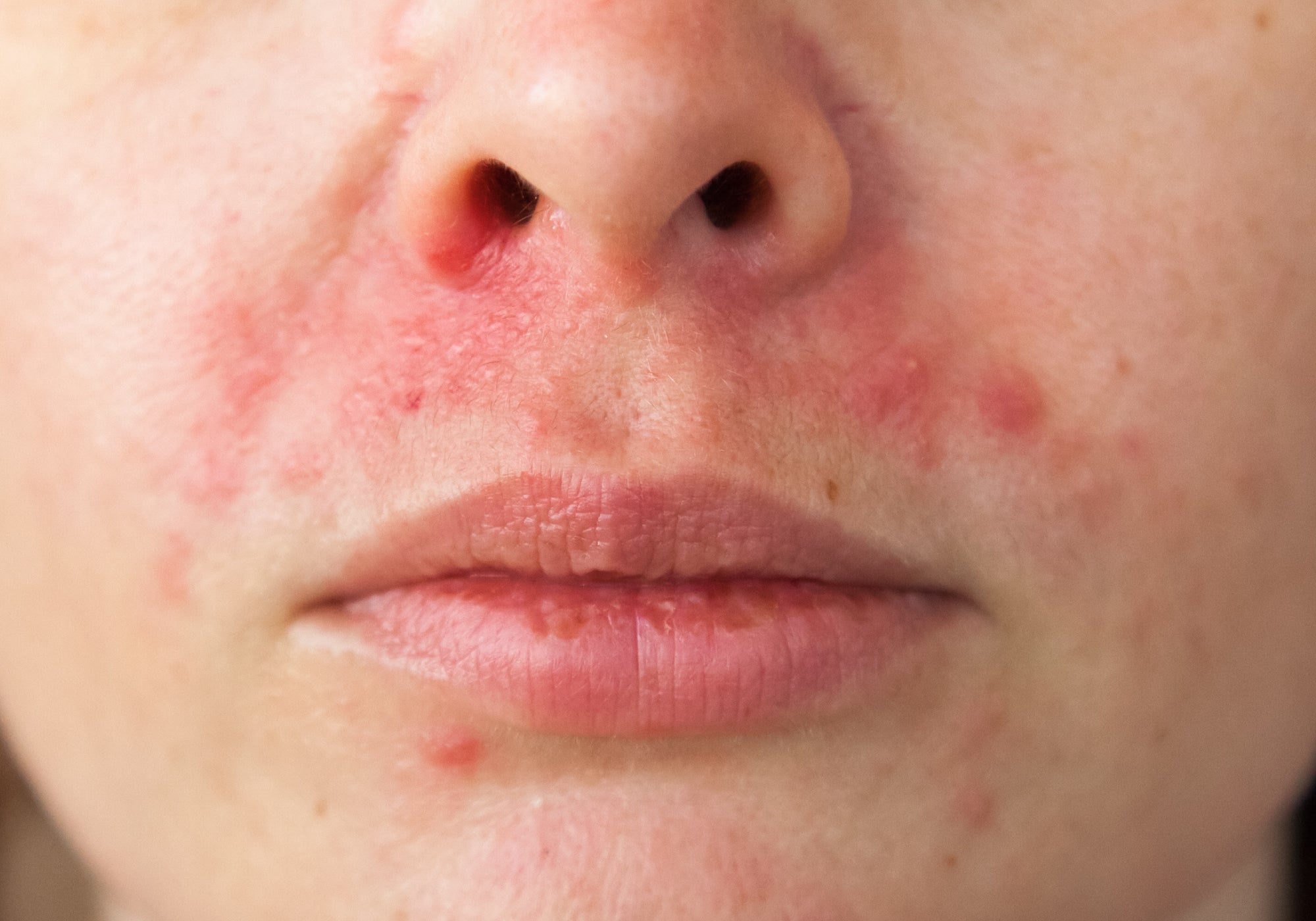 What Home Remedies Are Good For Perioral Dermatitis?