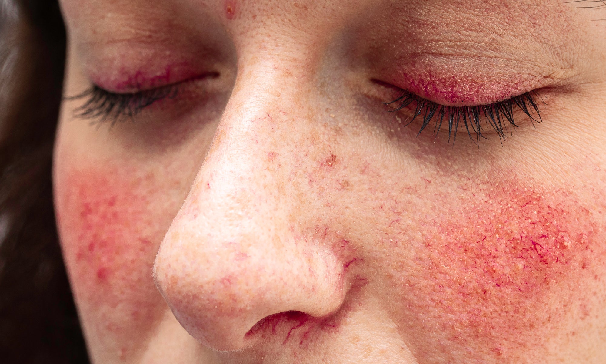 What Foods Trigger Rosacea?