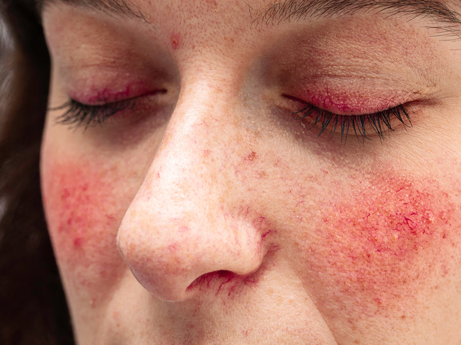 What Foods Trigger Rosacea?