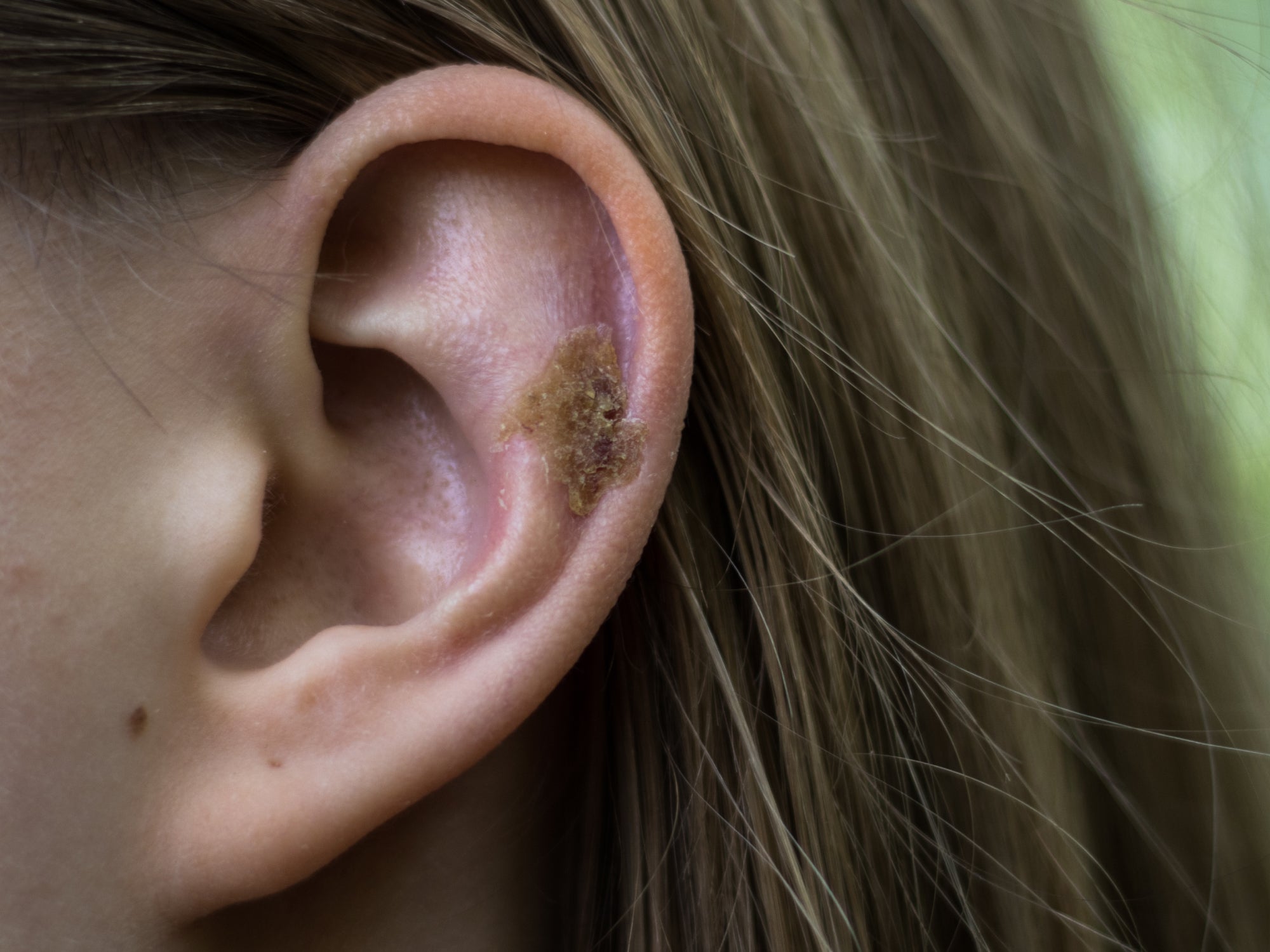 What Causes Scabs In My Ear? Balmonds