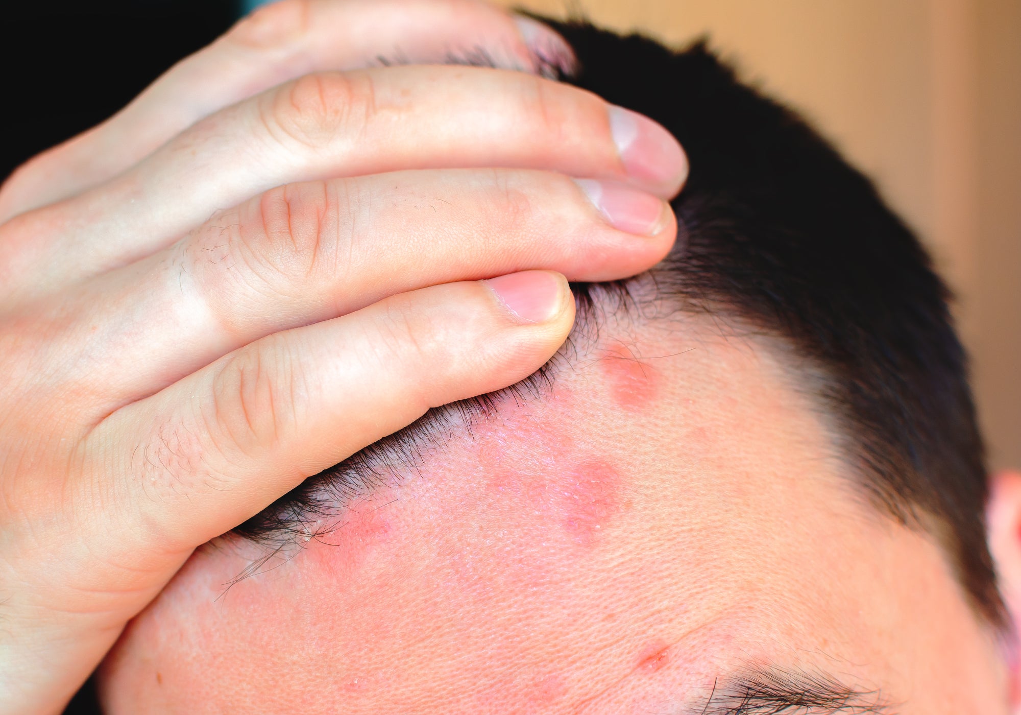 How To Get Rid Of Psoriasis Around The Hairline