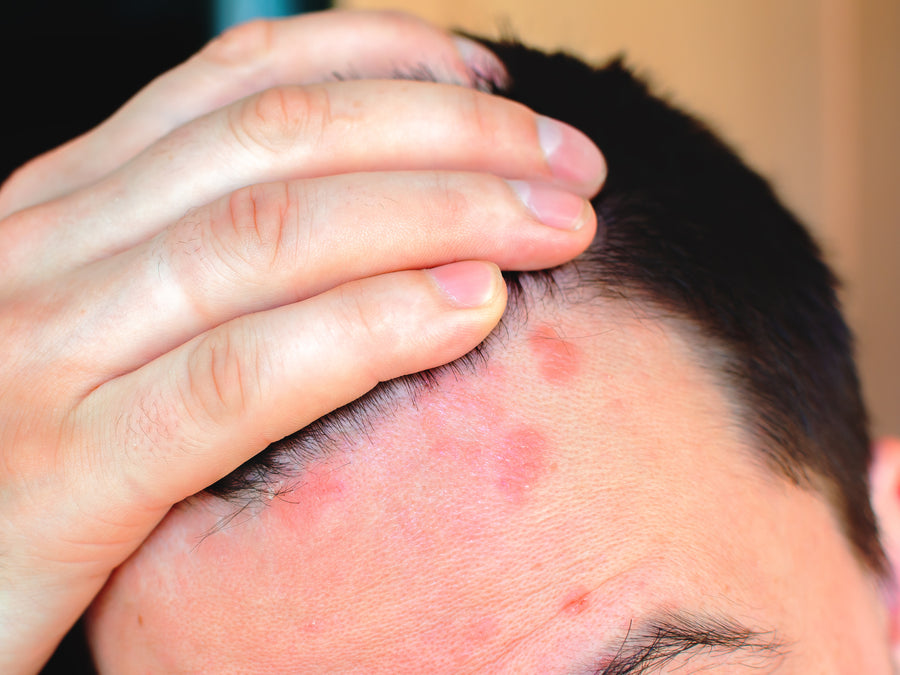 How To Get Rid Of Psoriasis Around The Hairline