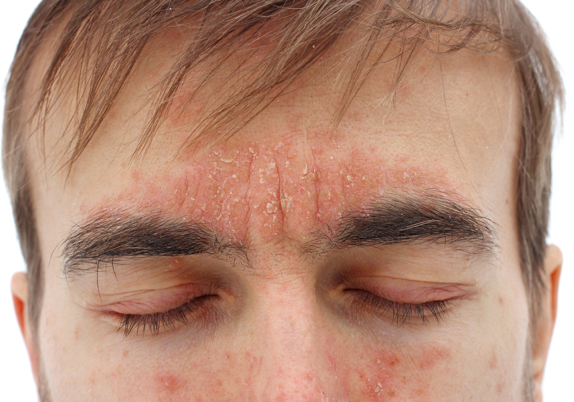 Is Seborrheic Dermatitis A Fungal Or Bacterial Infection?