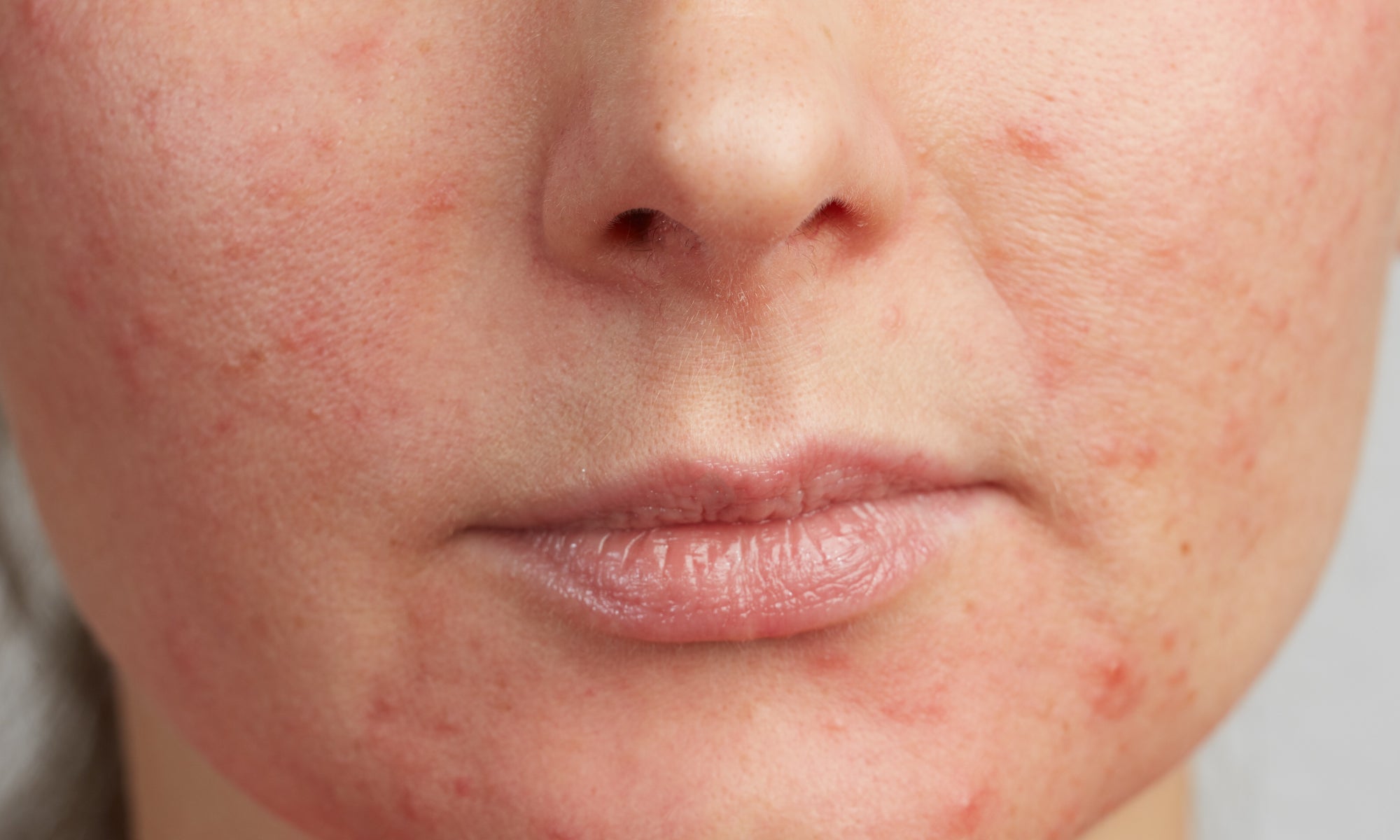 Should You Moisturize Perioral Dermatitis?