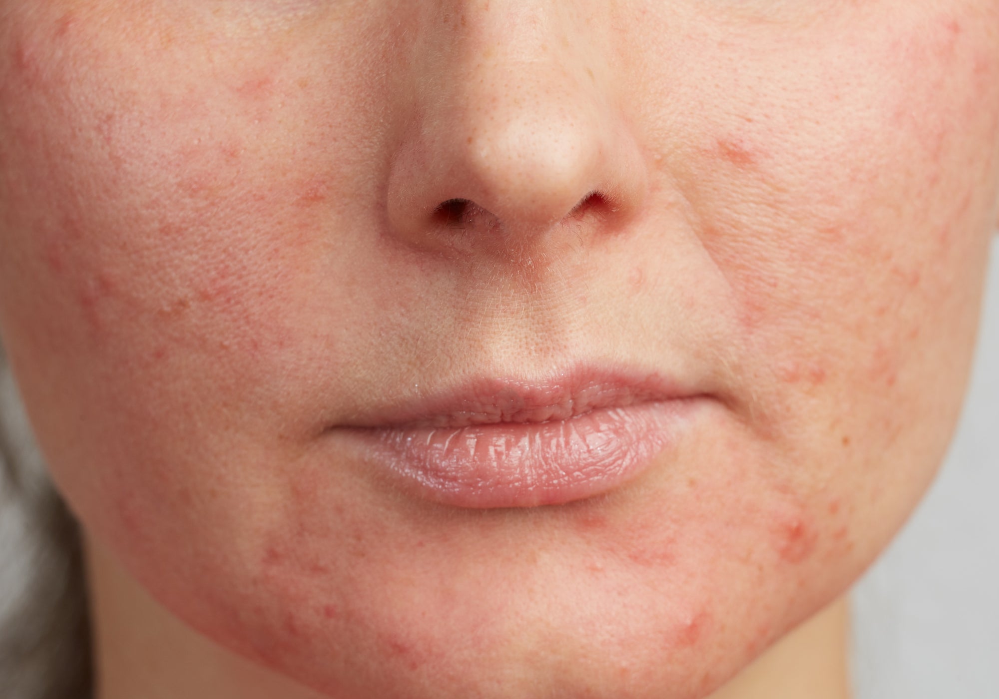 Should You Moisturize Perioral Dermatitis?