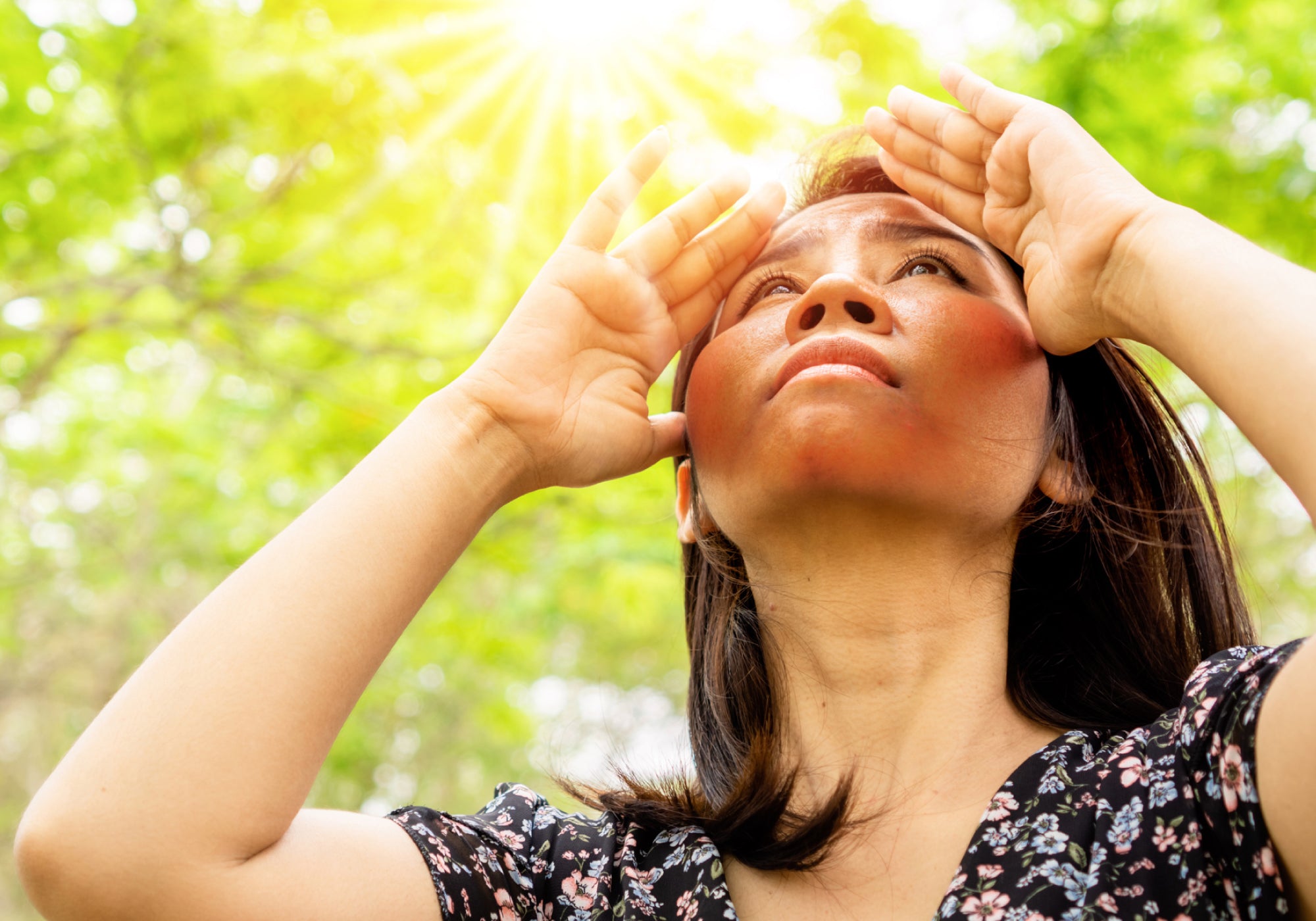 Does Sun Make Perioral Dermatitis Worse?