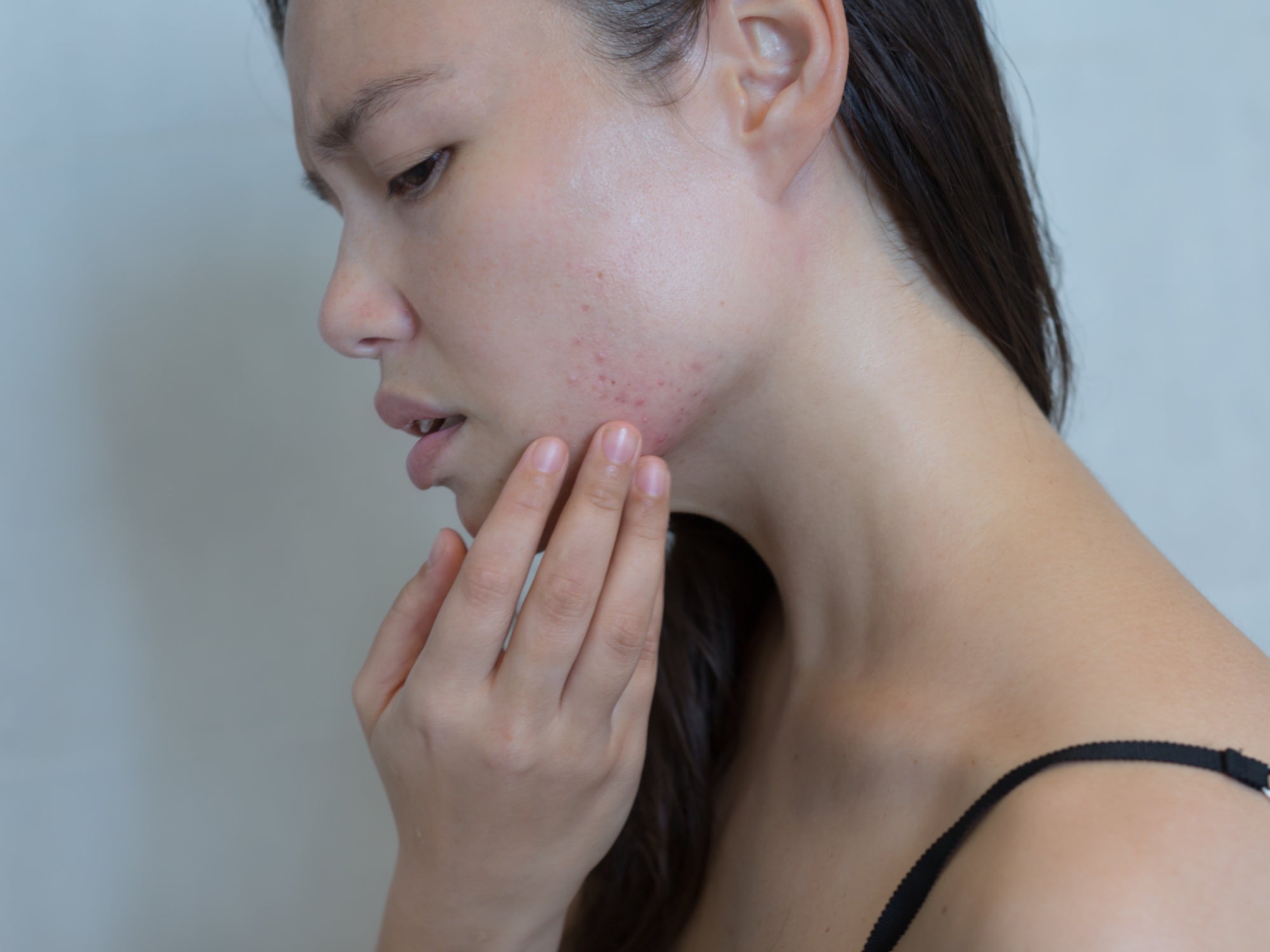 Top 8 Triggers Of Perioral Dermatitis 