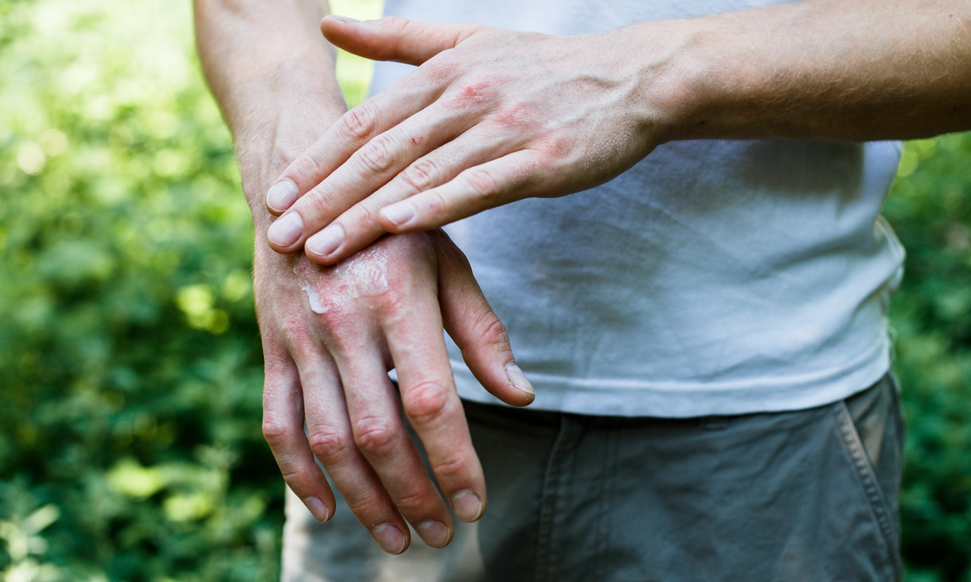 What Happens If Psoriasis Is Left Untreated?