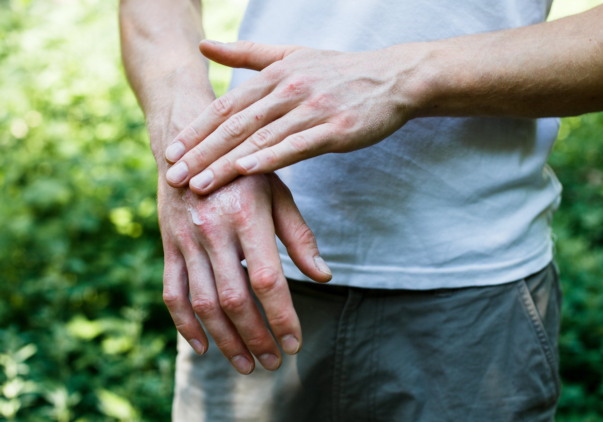 What Happens If Psoriasis Is Left Untreated?