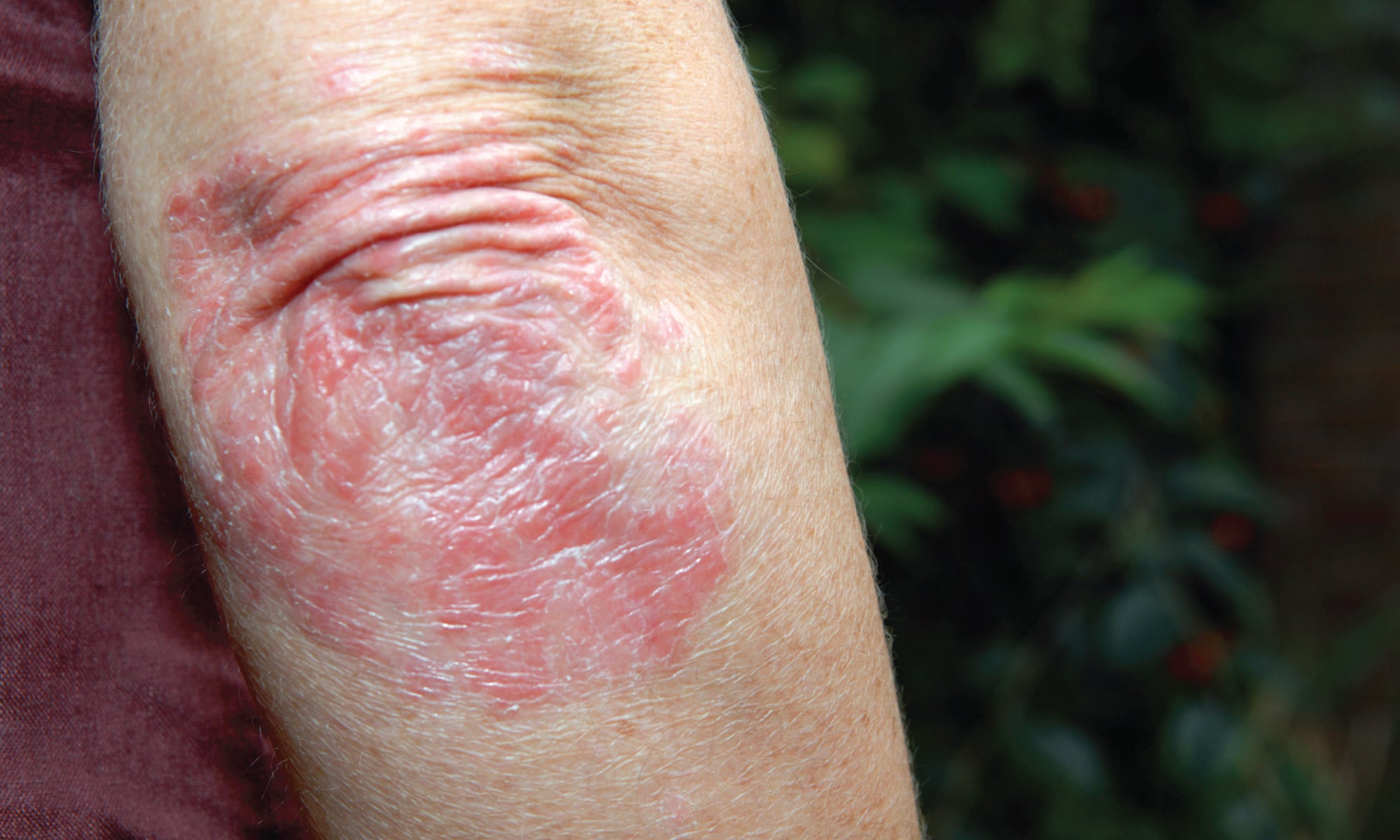 What’s The Main Cause Of Psoriasis?