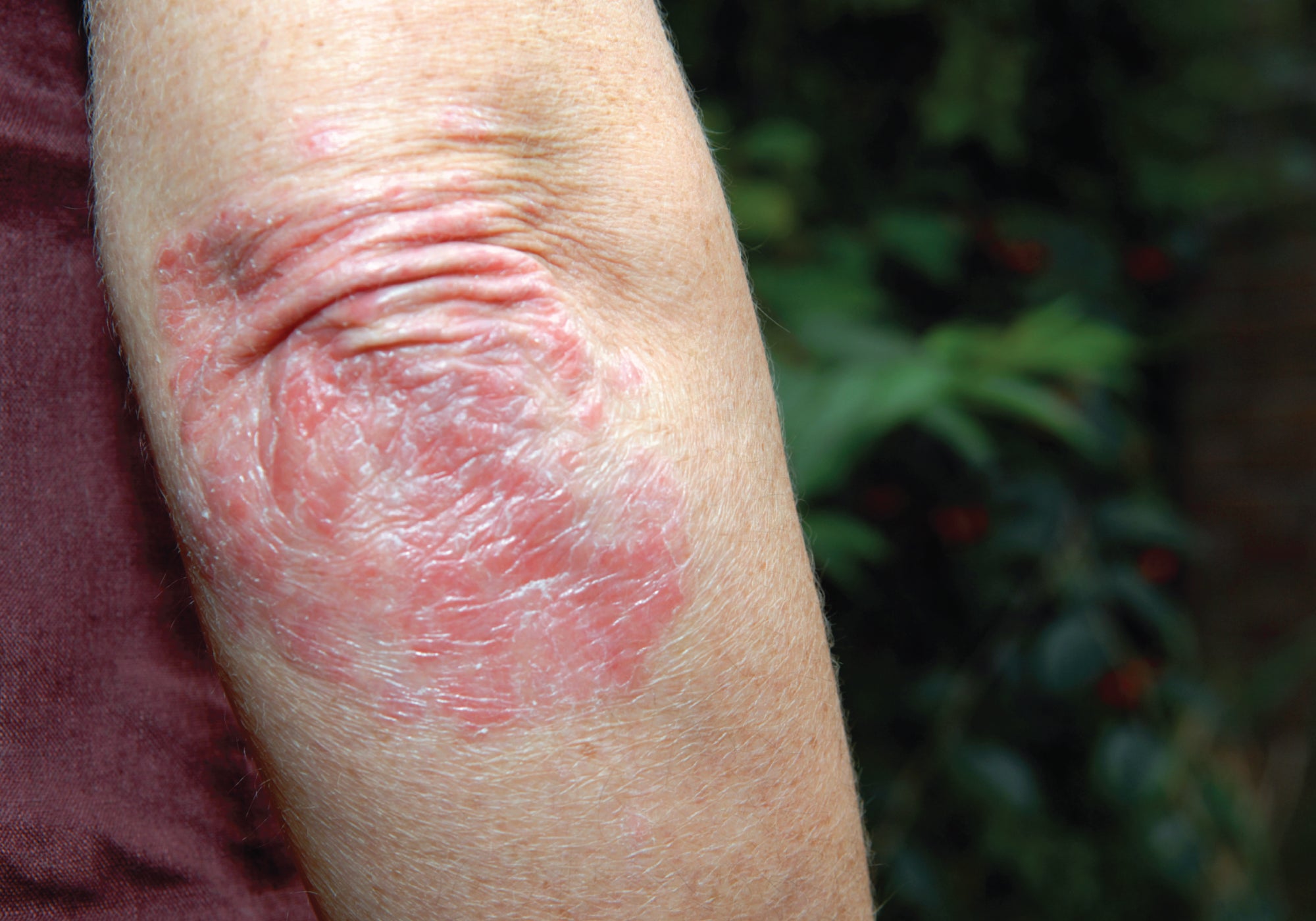 What’s The Main Cause Of Psoriasis?