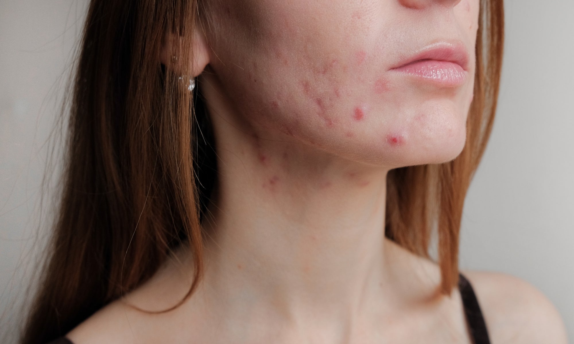 What Worsens Perioral Dermatitis?