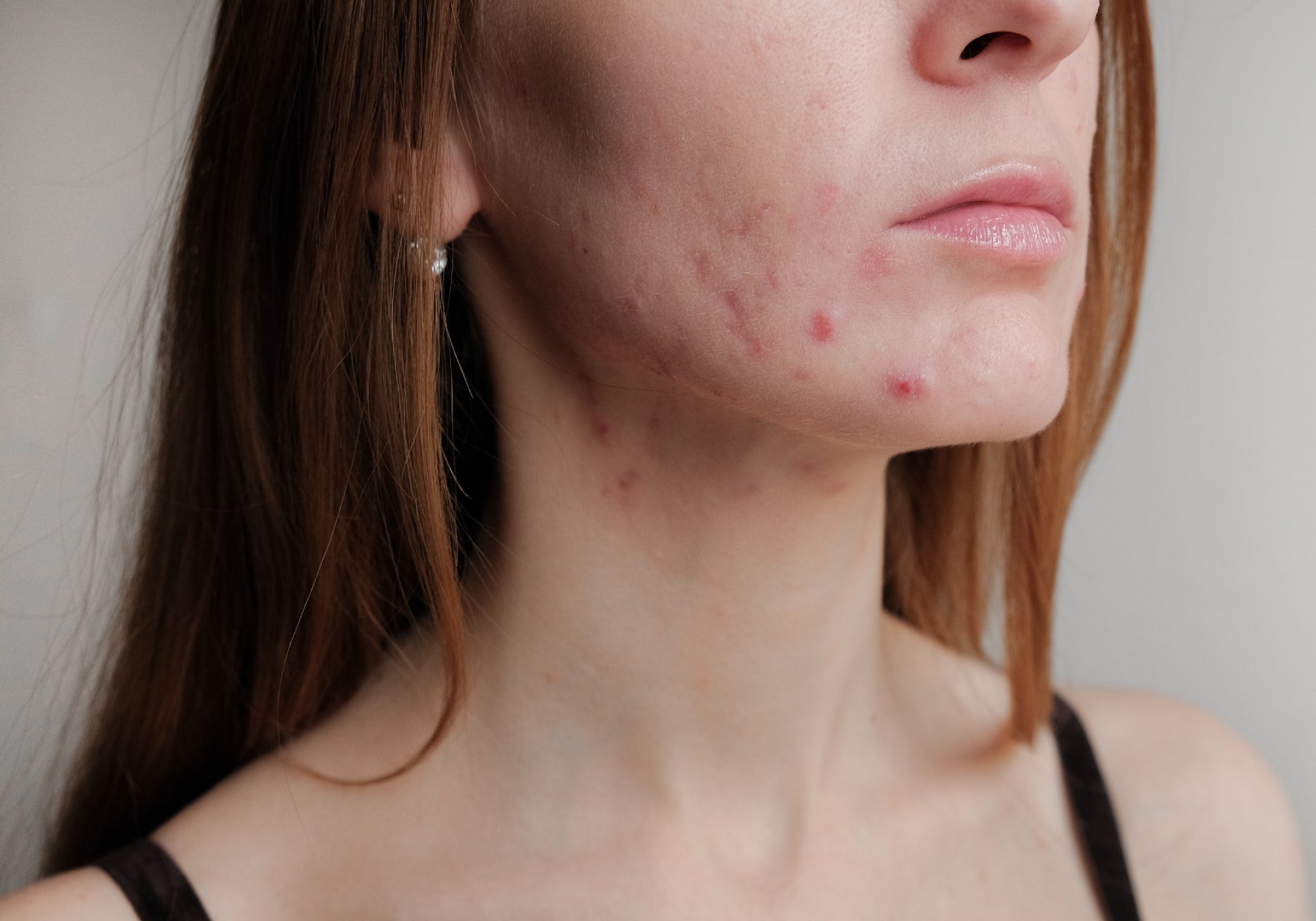 What Worsens Perioral Dermatitis?