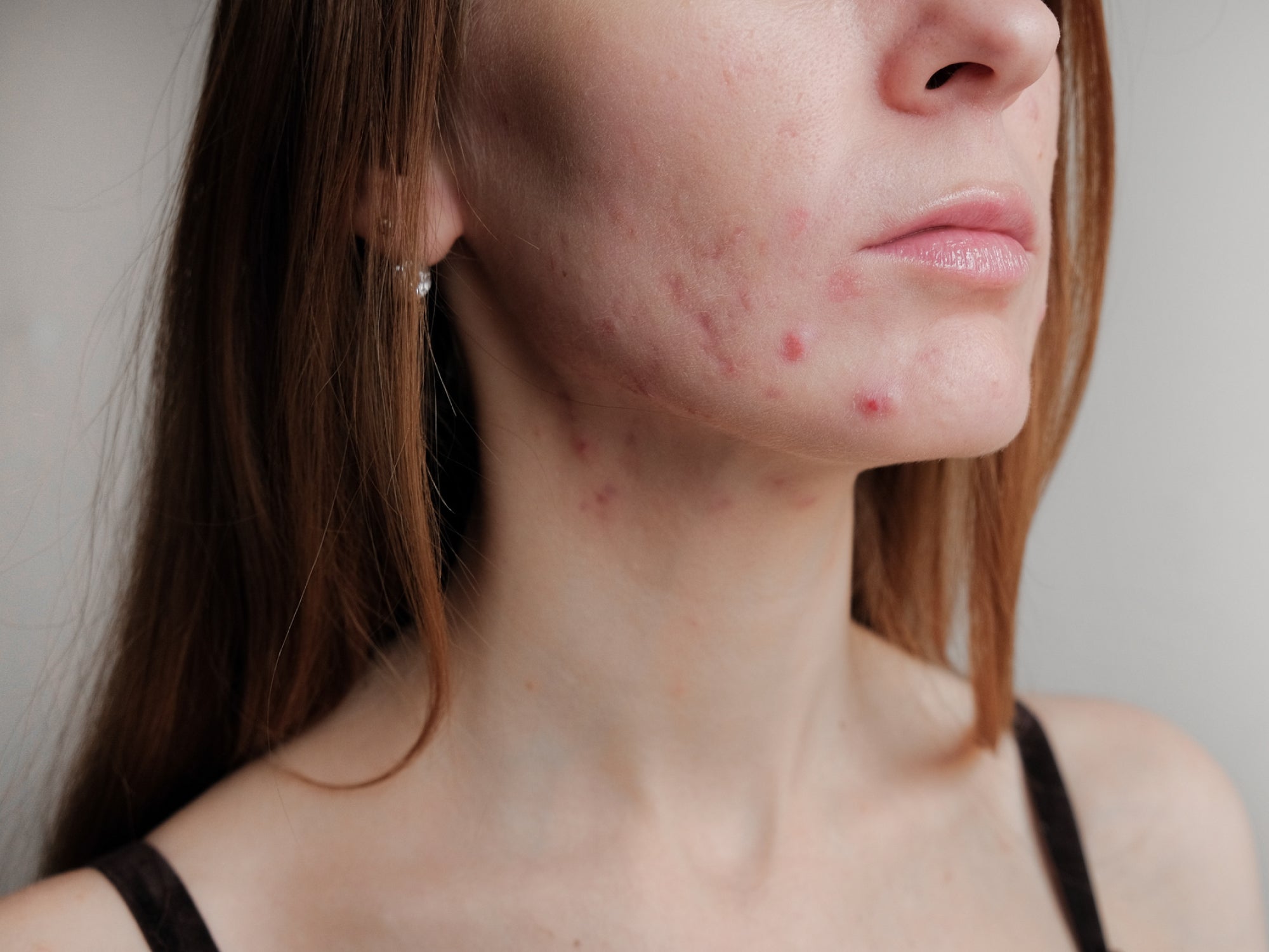 What Worsens Perioral Dermatitis?